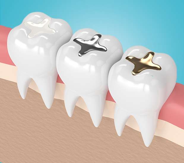 Coconut Creek Composite Fillings