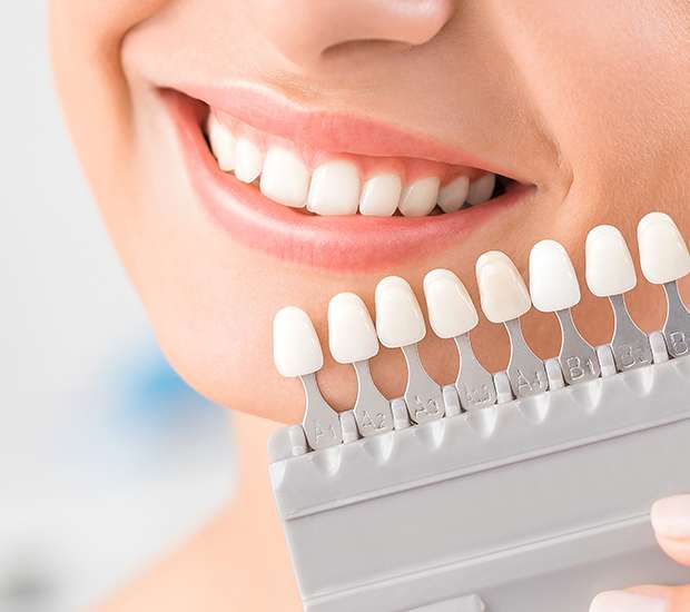 Coconut Creek Dental Veneers and Dental Laminates